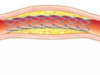 冠状动脉支架植入术