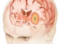 神经外科 | 脑胶质瘤小科普