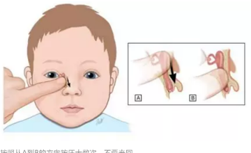 新生儿科 | 新生儿眼部分泌物