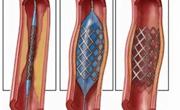 血管呵护指南 | 开通血管，支架还是搭桥？支架：治疗冠状动脉狭窄的主要手段